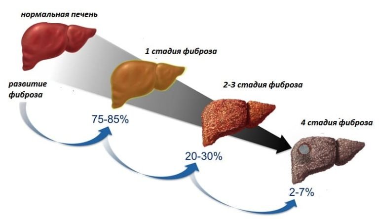 степени фиброза печени