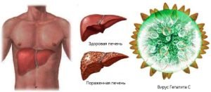 здоровая и больная печень