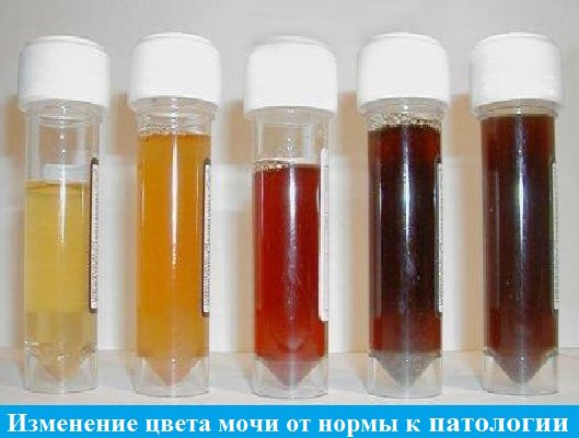 анализа мочи при гепатите С