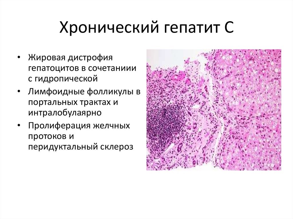 Ремиссия при хроническом гепатите С