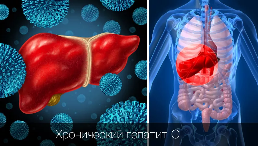 Обнаружена хроническая форма гепатита С